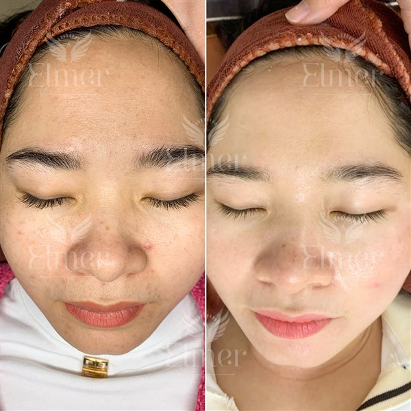 Trị nám