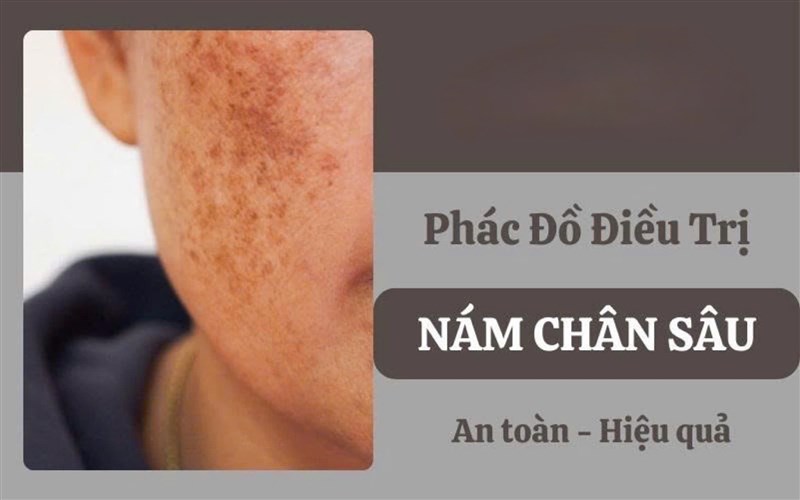 Điều trị nám chân sâu hiệu quả cần những yếu tố nào?