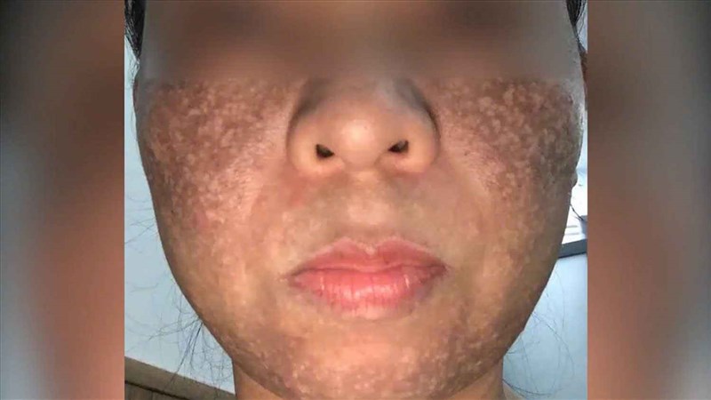 Có hay không việc “banh” mặt khách khi điều trị nám tại Phòng khám da liễu Elmer Quyên Nguyễn?