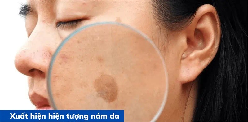 Vì sao da dễ bị nám theo thời gian? Những nguyên nhân nhiều người bỏ qua