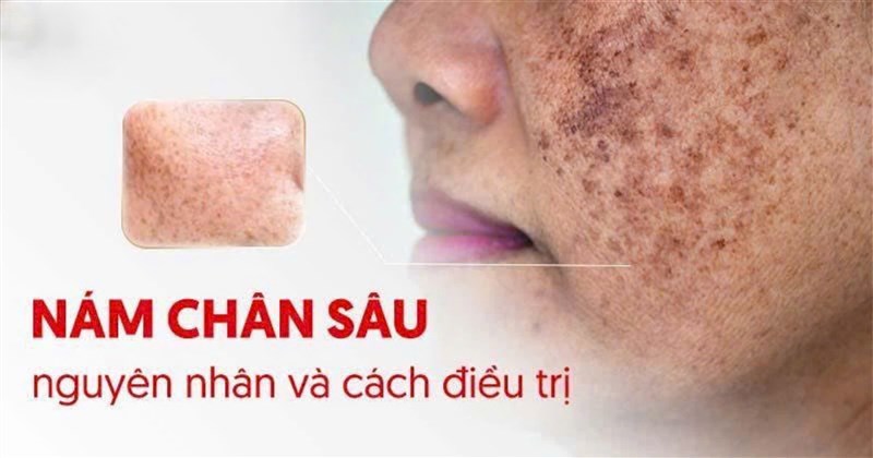 Nguyên nhân gây nám chân sâu thường gặp và cách nhận biết sớm