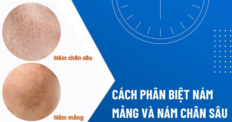 Phân biệt nám chân sâu và nám mảng: Nhận biết đúng để điều trị hiệu quả