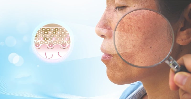 Nám da có chữa khỏi không? Góc nhìn từ chuyên gia da liễu