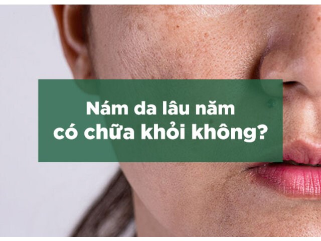 Nám da lâu năm có chữa khỏi không? Sự thật về điều trị nám