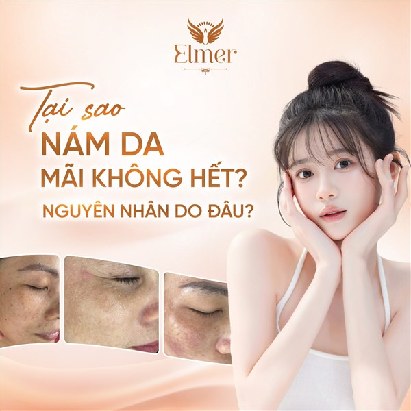 Vì Sao Trị Nám Hoài Không Hết Dù Đã Thử Nhiều Cách?