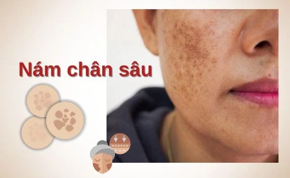Điều trị nám chân sâu có khỏi không? Sự thật bạn cần biết trước khi điều trị