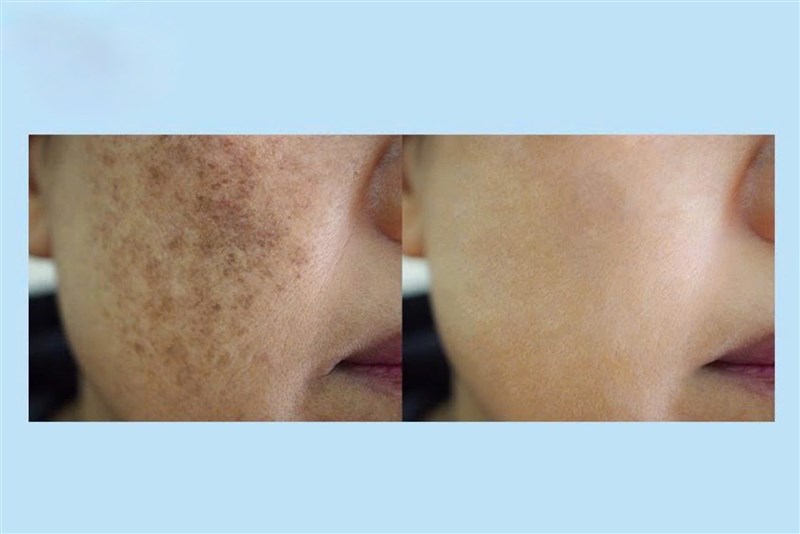 Thời điểm trị nám chân sâu: Khi nào nên điều trị nám chân sâu để không lãng phí tiền