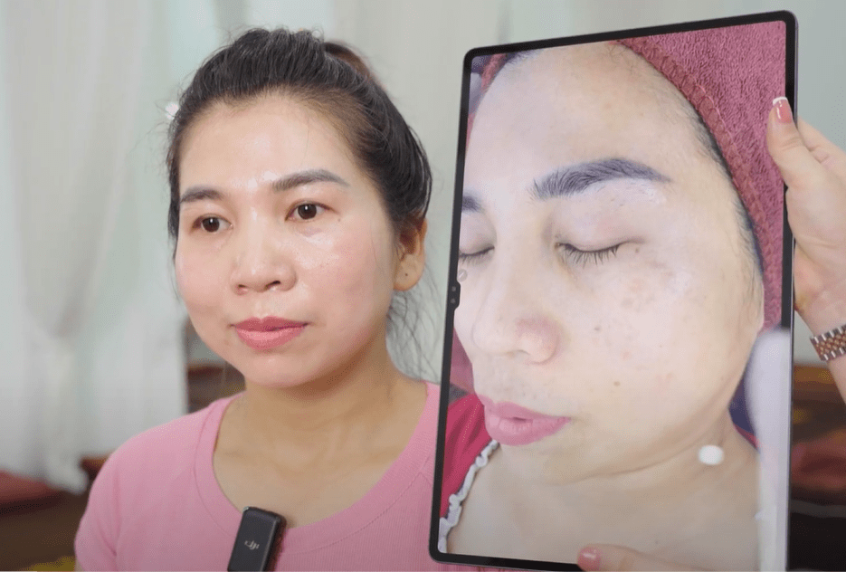 Phác đồ nám cá nhân hóa tại Elmer Quyên Nguyễn