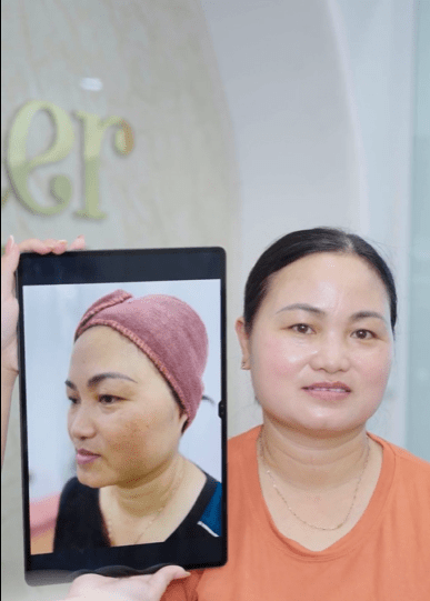 Phác đồ nám cá nhân hóa tại Elmer Quyên Nguyễn